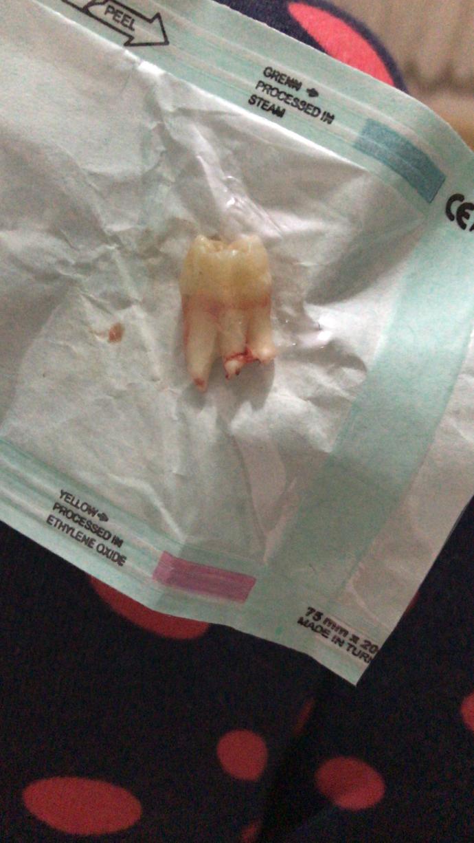 Yirmilik dişimi çektirdim ve doktor ilk defa böyle bir kök olduğunu söyledi kökü böyle çıkan arkadaşlar var mı ?