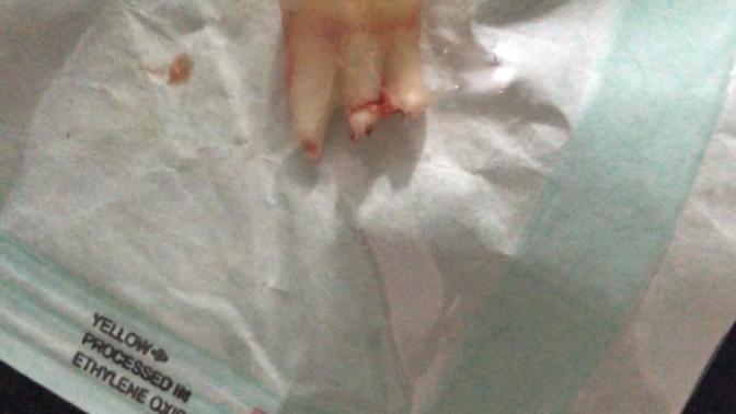 Yirmilik dişimi çektirdim ve doktor ilk defa böyle bir kök olduğunu söyledi kökü böyle çıkan arkadaşlar var mı?