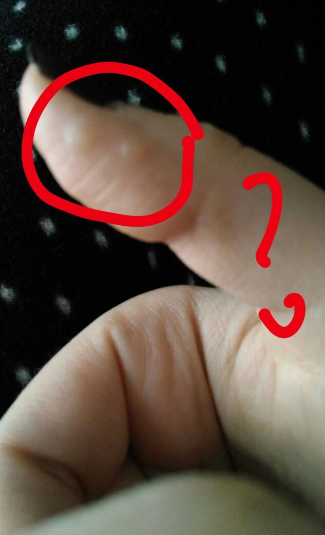 Bu siğil nasıl geçer??