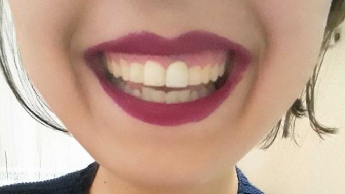 Smiley Piercing Sizce yakışır mı bana?