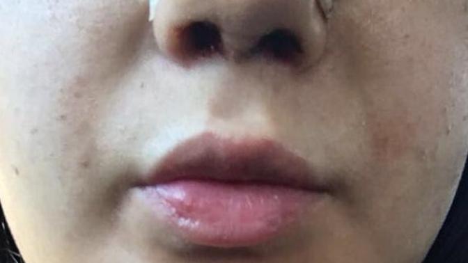 Burun estetiği oldum dudağımın şekli değişti? (Fotoğraflı) ?