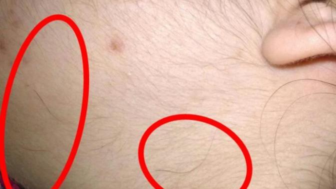Boynumda çenemde ve yanağımda kıl çıktı?