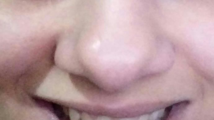 Gülümseyince burnum genişliyor bunun için napabilirim estetik hariç egzersiz vb bilen varmı?