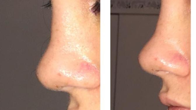 Burun estetiği oldum ve çok pişmanım nolur yardım edin fotoğrafta çok mu kötü?