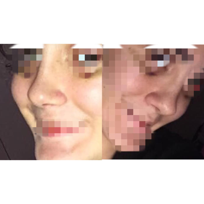 Burnum ameliyat sonrası iki profilden de farklı neden böyle oldu :( (Fotoğraflı) ?
