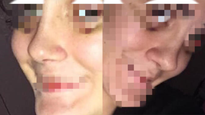 Burnum ameliyat sonrası iki profilden de farklı neden böyle oldu :( (Fotoğraflı) ?