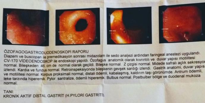 endoskopi sonucum yardımcı olabilirmisiniz?