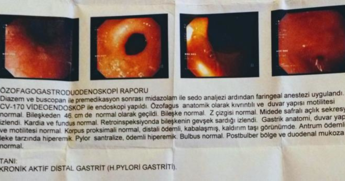 Endoskopi sonucum yardımcı olabilirmisiniz? KizlarSoruyor