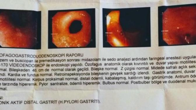 Endoskopi sonucum yardımcı olabilirmisiniz?