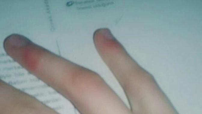 Sizin de soğuktan parmaklarınız şişiyor mu?