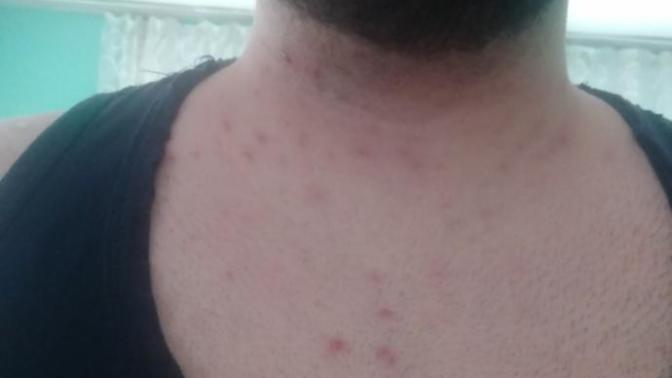 Sivilce ve çıban izleri?