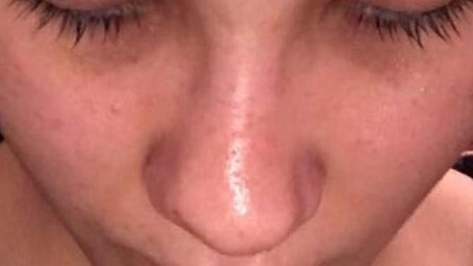 Burun estetiği olanlar yardım edebilir mi ucu yamuk mu sizce? (Fotoğraflı) ?