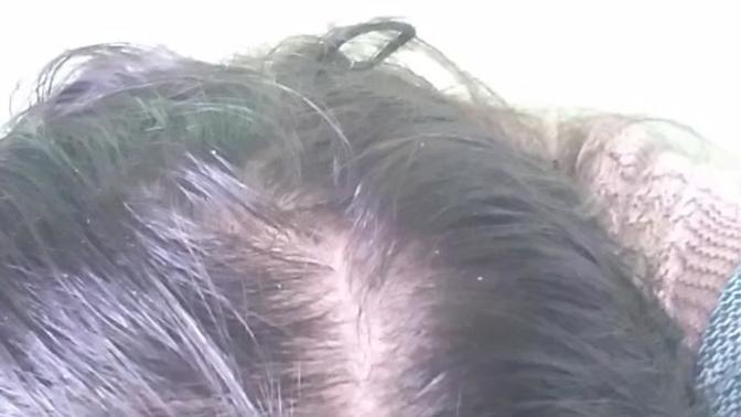 Tepe bölgem seyrelmiş ne yapabilirim?