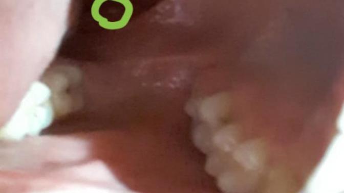 Boğazımın içinde küçük sarı  bir  nokta var?