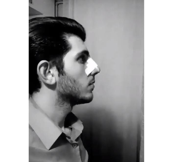 X2 Burun estetiği oldum, olmuşmu?