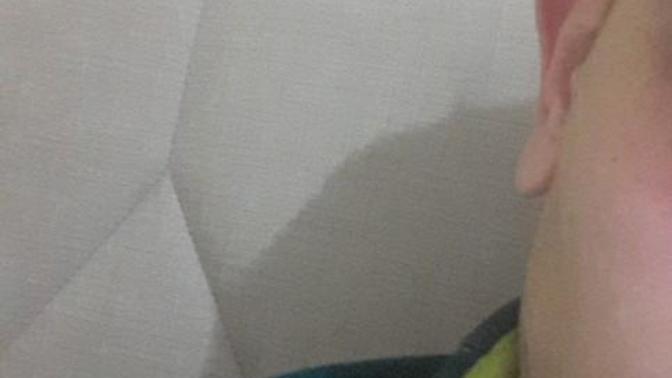 Kepçe kulak estetiği?