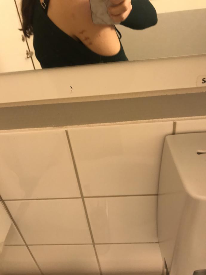 Spor yapiyorum, cilt catlagi cikti? Lutfen yardimci olun?