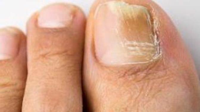 Resimdeki Şekilde Ayak tırnağımın  bir  kısmında Karartı olmuştu.. Sorunu buldum. Ama nasıl geçeciğini bilmiyorum. Yaşayan varmı?