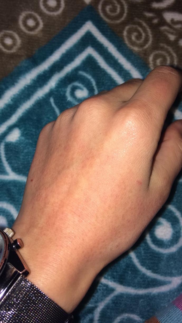 Güneş yanığı gibi ama değil.. Roaccutane kullananlar?