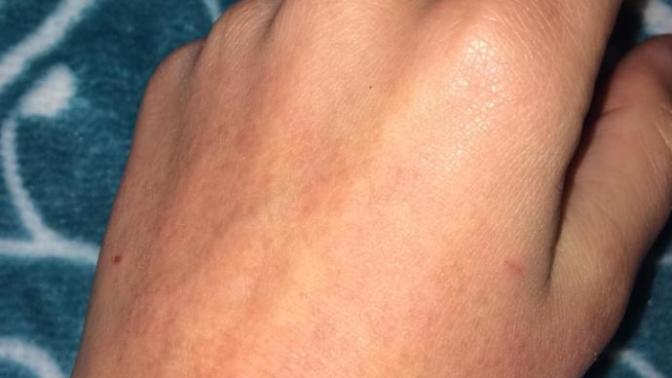 Güneş yanığı gibi ama değil.. Roaccutane kullananlar?