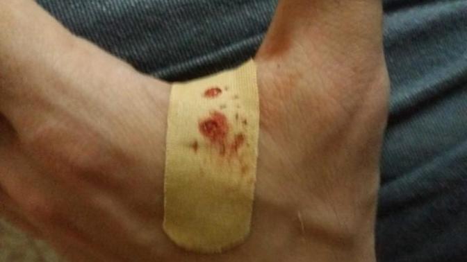 Arkadaslar elimin ustunu yanlislikla kestim resimli?