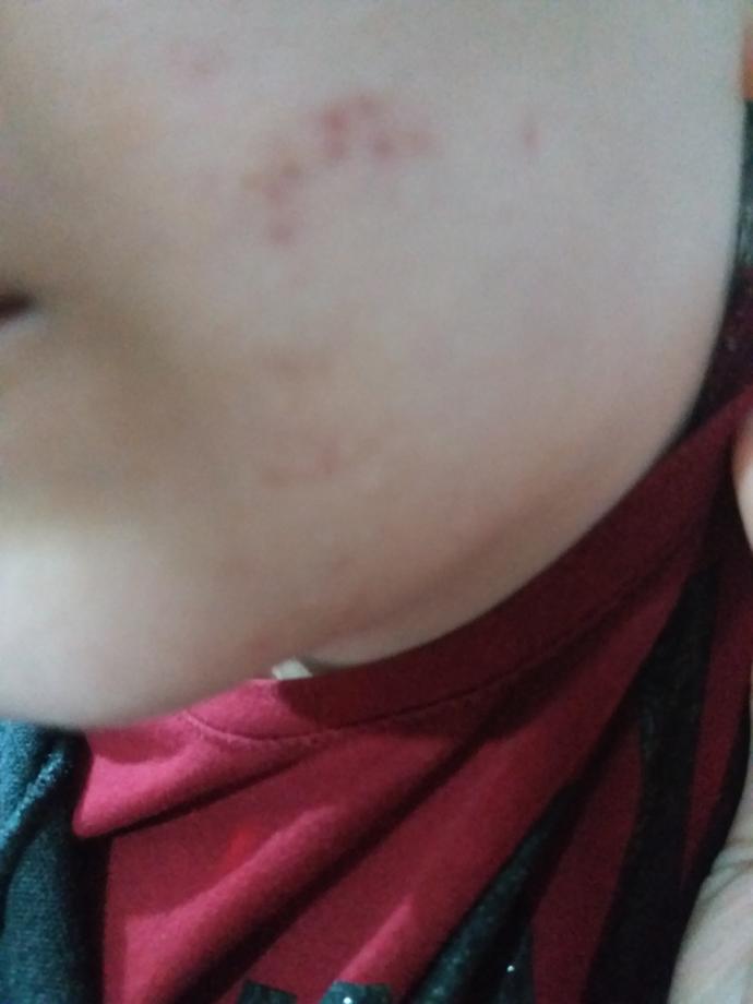 Cilt lekesi kesin çözüm?