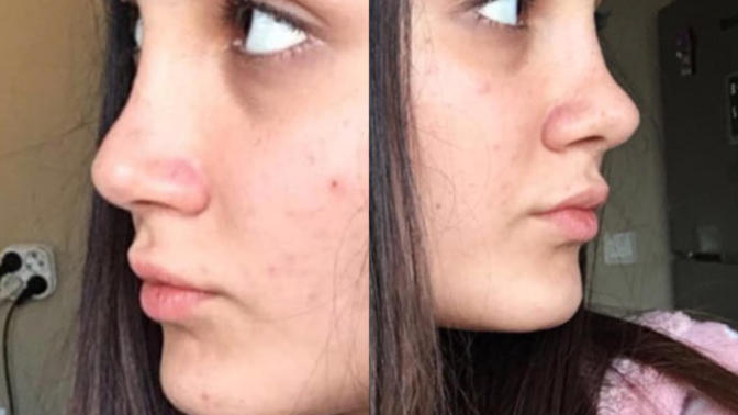 Burun estetiği sonrası iki yandan farklı görünüyor sizce neden (fotoğraflı)?