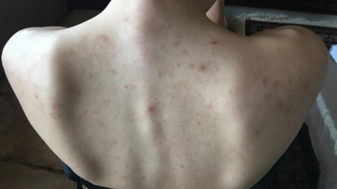 Doktor sivilce lekelerim için krem yerine direk Roaccutane verdi sizce bu kadar ağır bir ilaç kullanmama gerek var mı?