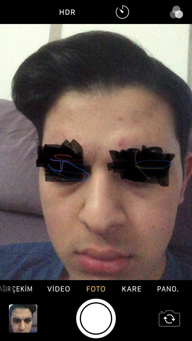 Benim göz altı torbalarım çok belirgin nasıl normal bir hal alır<br />?