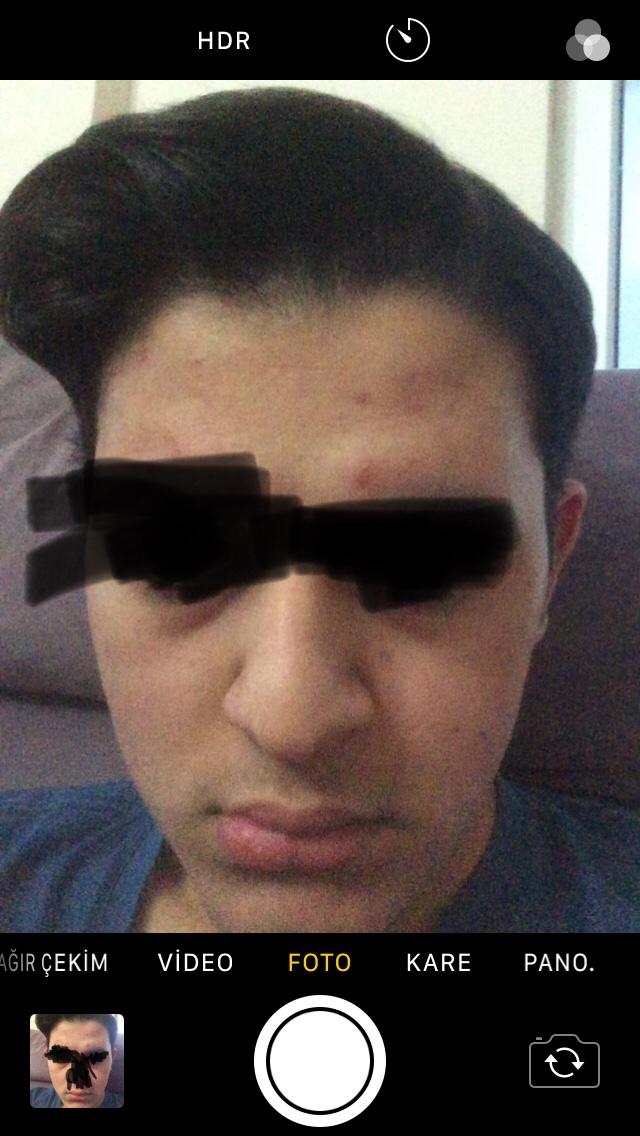 Benim göz altı torbalarım çok belirgin nasıl normal bir hal alır<br />?