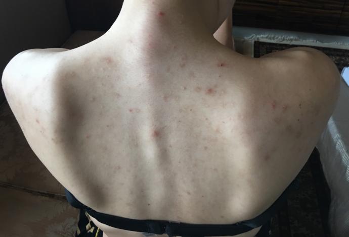 Sırtımdaki bu sivilce lekeleri nasıl geçer ? Doktora gittim Roaccutane verdi ama leke giderici kremlerle falan geçmez mi?