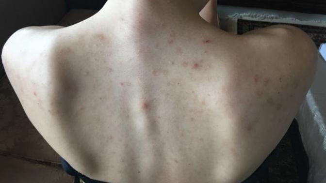 Sırtımdaki bu sivilce lekeleri nasıl geçer? Doktora gittim Roaccutane verdi ama leke giderici kremlerle falan geçmez mi?