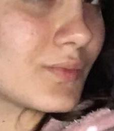 Burun estetiği olanlar yardım edebilir mi sizce bu şişlik mi? (Fotoğraflı) ?