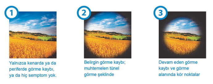 Glokom (göz tansiyonu) nedir? Belirtileri nelerdir? Tedavisi var mıdır?