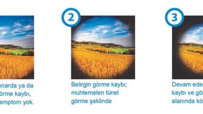 Glokom (göz tansiyonu) nedir? Belirtileri nelerdir? Tedavisi var mıdır?
