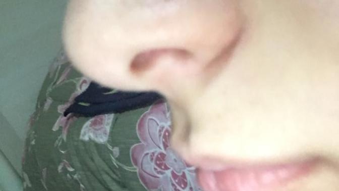 Burnumda 2senedir yağ bezesine benzeyen bir nokta var ve birtürlü kaybolmuyo nasıl gider?