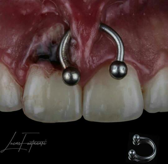 smiley piercing'in sağlığa zararları var mıdır varsa bunlar neler??