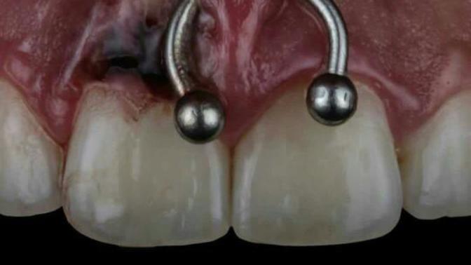 Smiley piercing'in sağlığa zararları var mıdır varsa bunlar neler?