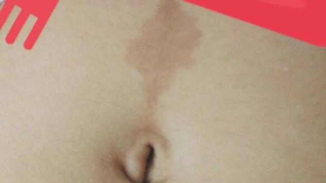 Göbeğimde böyle bir leke var hoşuma gitmiyor. Aldırmak mümkün mü?