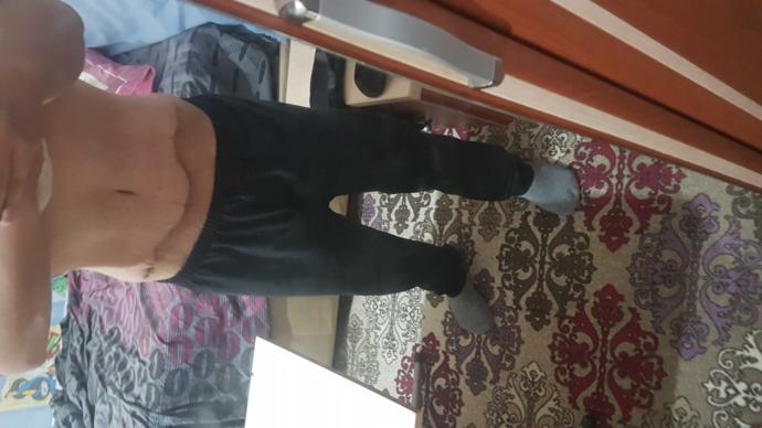 Karin germe oncesi ve sonrasi yorumlarinizi alirim 😄 ??