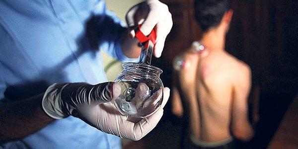 Hacamat, sülük, akupunktur gibi alternatif tıp tedavileri SGK reçetesine giriyor! Siz bu yöntemleri uygulatır mısınız?