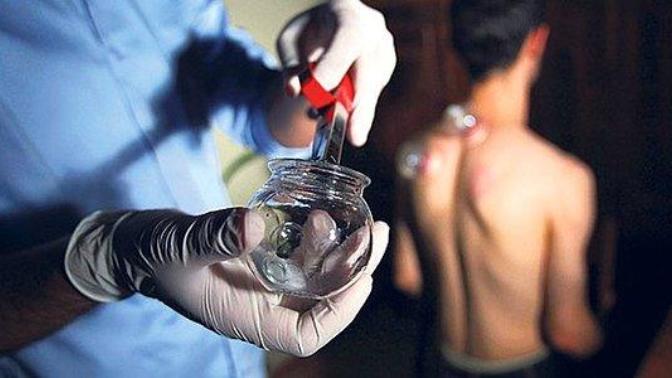 Hacamat, sülük, akupunktur gibi alternatif tıp tedavileri SGK reçetesine giriyor! Siz bu yöntemleri uygulatır mısınız?