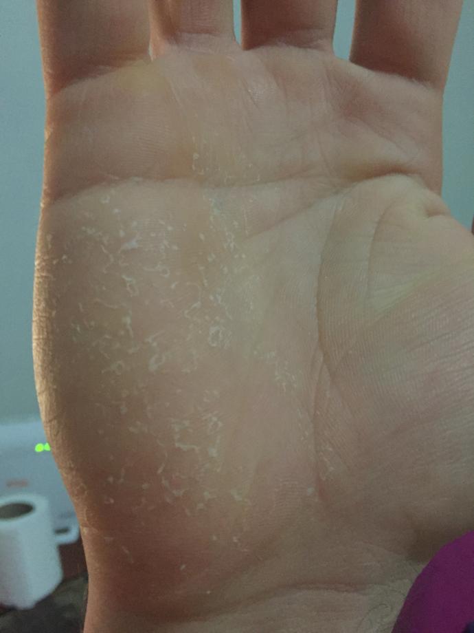 ELİM 3 gündür böyle bu mantar belirtisi mi ? Yoksa deri döküntüsü falan mı ? Sadece sağ elimde var bakar mısınız rica etsem ? 