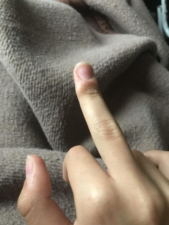 Parmağımda çıkan şey ne?