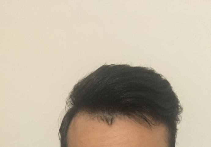 Saç çizgisindeki anormal küçük saçlar ?