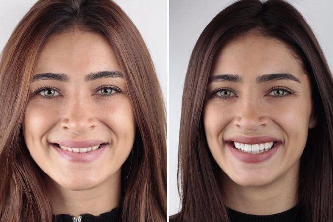 Gülüş tasarım estetiği güzel gülümseme için en iyi yöntem ! Sizin gülüşünüz estetik gerektiriyor mu?