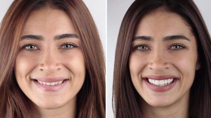 Gülüş tasarım estetiği güzel gülümseme için en iyi yöntem! Sizin gülüşünüz estetik gerektiriyor mu?