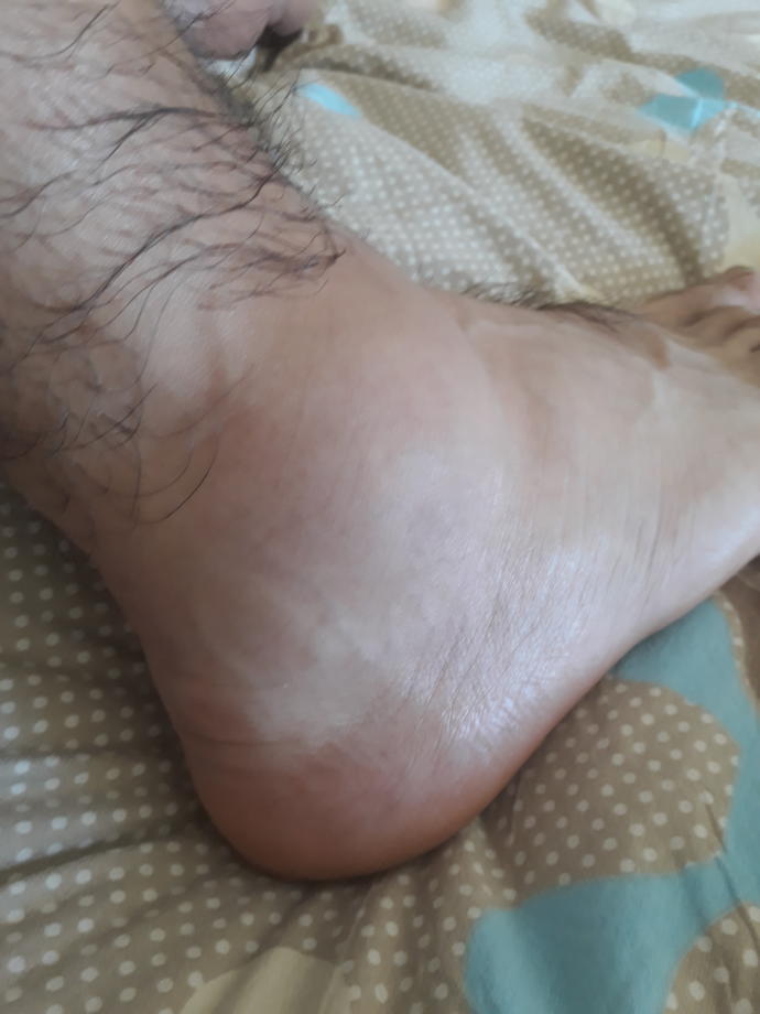 Merhabalar, daha önce ayak bileği çıkığı yaşayanlar oldu mu ? Daha önce de burkmustum ama yine burktum üstüne? Bu çıkık mi ?