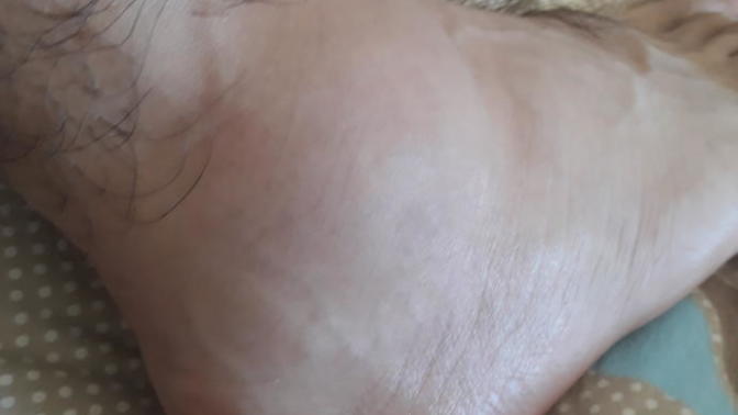 Merhabalar, daha önce ayak bileği çıkığı yaşayanlar oldu mu? Daha önce de burkmustum ama yine burktum üstüne? Bu çıkık mi?