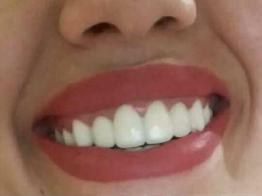 Dişlerim nasıl sizce ???